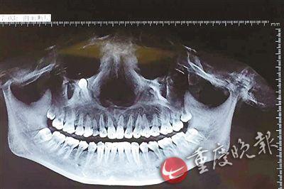 埋伏牙顶到了眼球