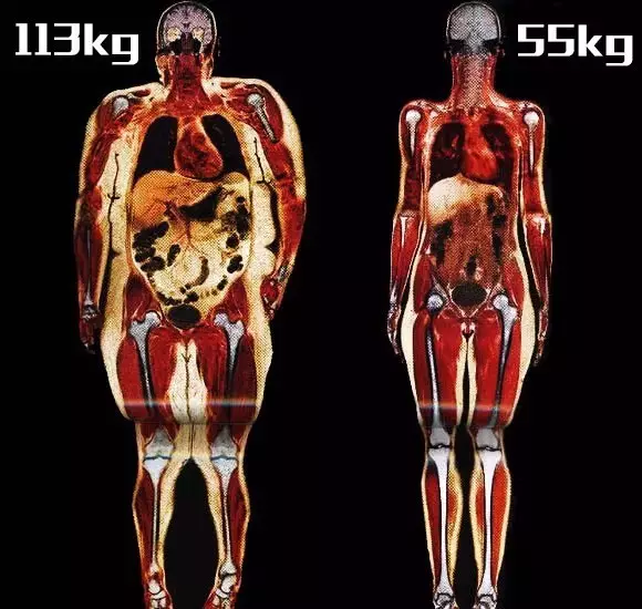 相同身高下，肥胖者与正常者皮下脂肪对比